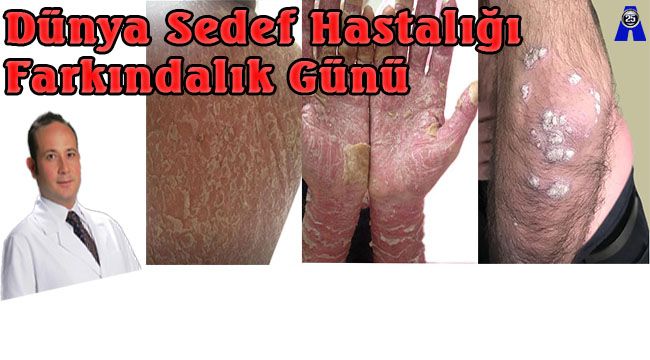 Doç. Dr. Melikoğlu: "Sedef hastalığı bulaşıcı değildir, tedavisi mümkündür"