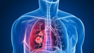 Risk, 20 kat daha fazla